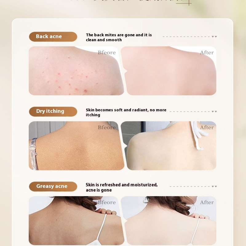 Anti-Acne Body Shower Gel – Clarifying Body Wash for Bacne, Chest Acne & Blemish-Prone Skin