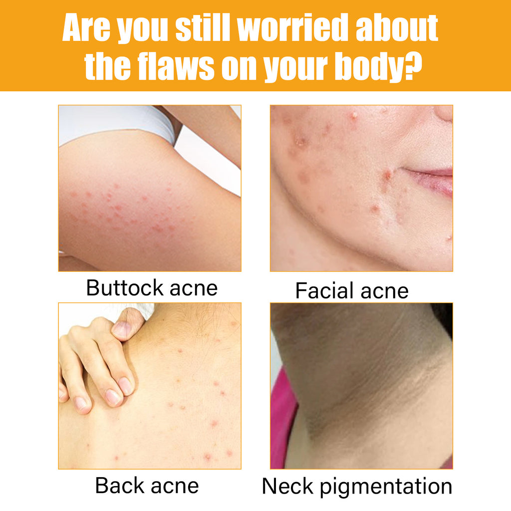 Acne Treatment Essence